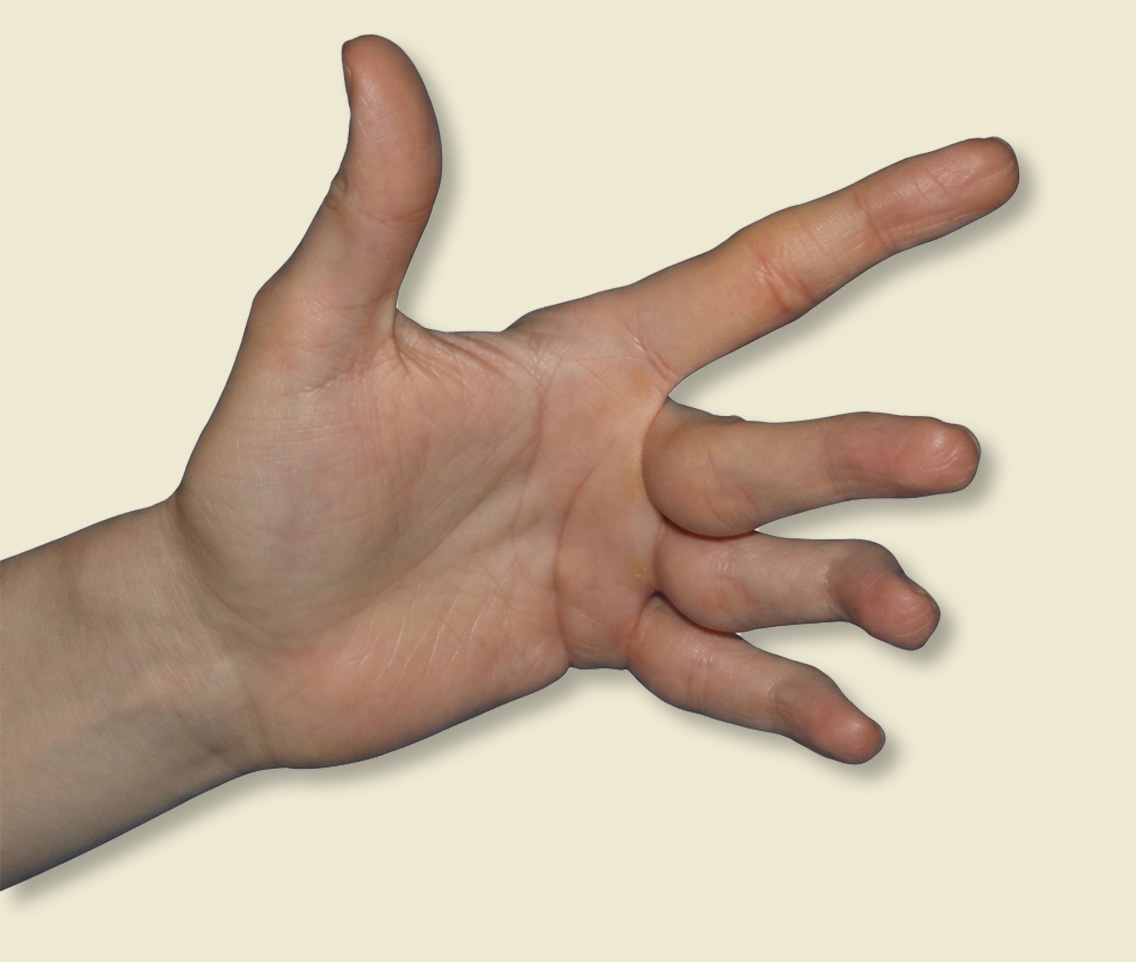 BG